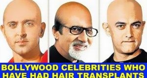 Top 10 Bollywood Celebrities who have had Hair transplants