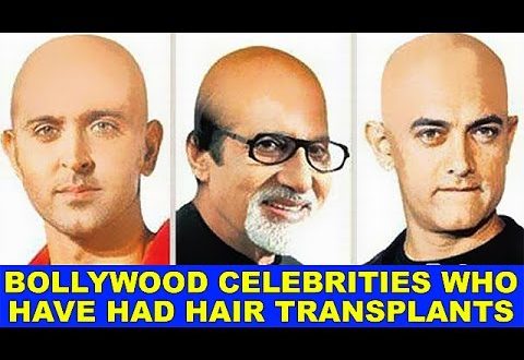 Top 10 Bollywood Celebrities who have had Hair transplants